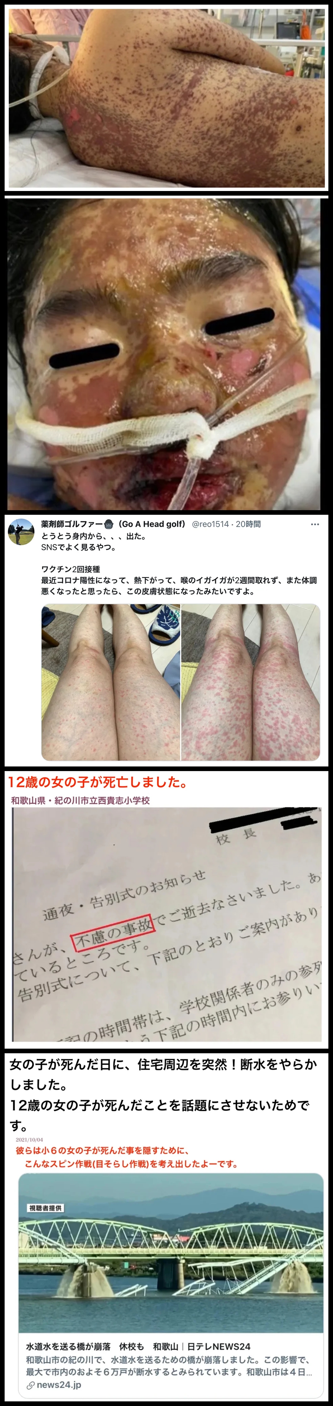 高校生のブログからの引用画像　。毒ワクチンの被害の酷い皮膚症状と水道の目くらましの事故